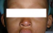 Loạn sản ngoại bì ở trẻ em 