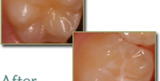 Trám bít hố rãnh bằng sealant ở trẻ em là gì ? 