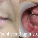 Cấy ghép răng implant 8