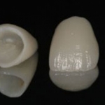 HỆ THỐNG SỨ E.MAX TẠI AVA