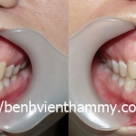 Bệnh nhân bị tai nạn gãy răng cửa giữa R11,21